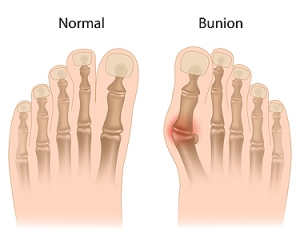 Why Do I Have a Bunion?