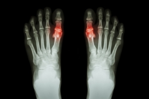 Managing Gout